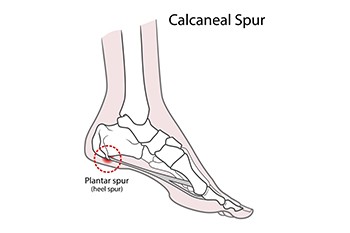 Heel spurs and plantar fasciitis deals