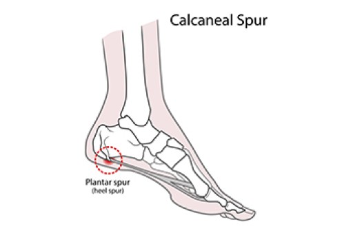 Calcaneal Spur - By Dr. Qaisar Raza | Lybrate