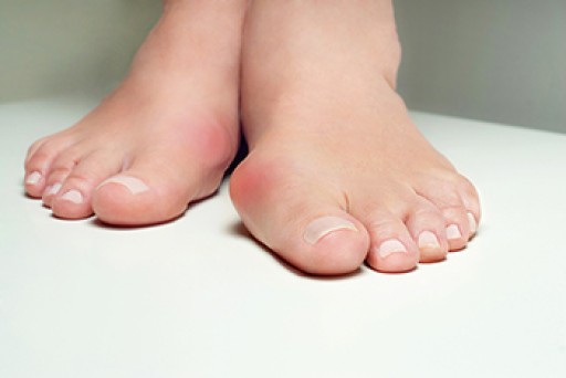 Causes and Risk Factors of Bunions
