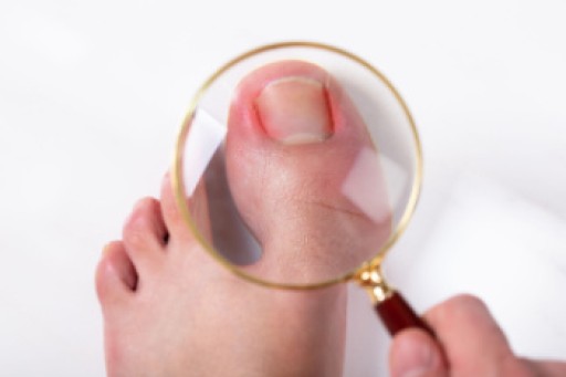 Symptoms and Causes of Ingrown Toenails