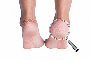 Baby foot cracked heels clearance