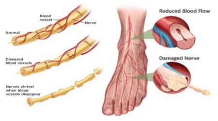 wound care